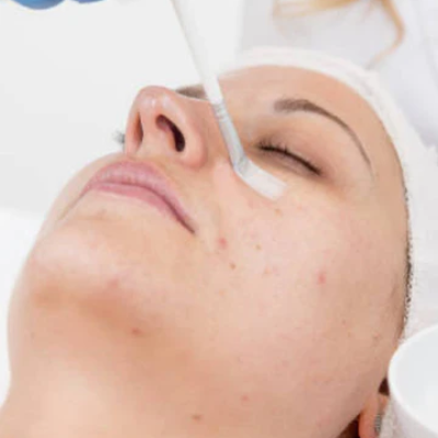 Blemish / Hyperpigmentation Peel