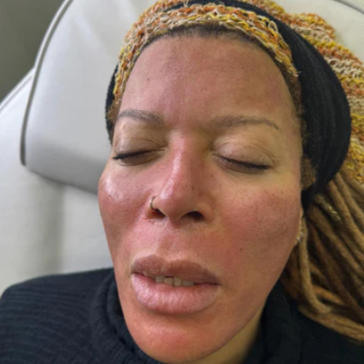 Microneedling Facials