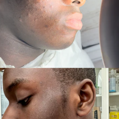 Bespoke acne clarifying facials