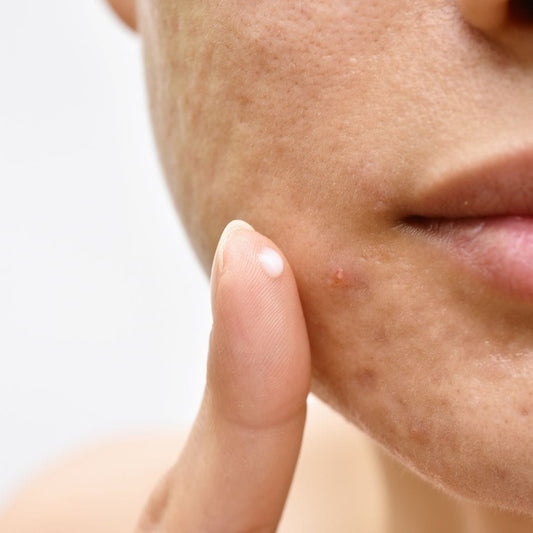 Top Home Remedies for Acne and a Professional Touch