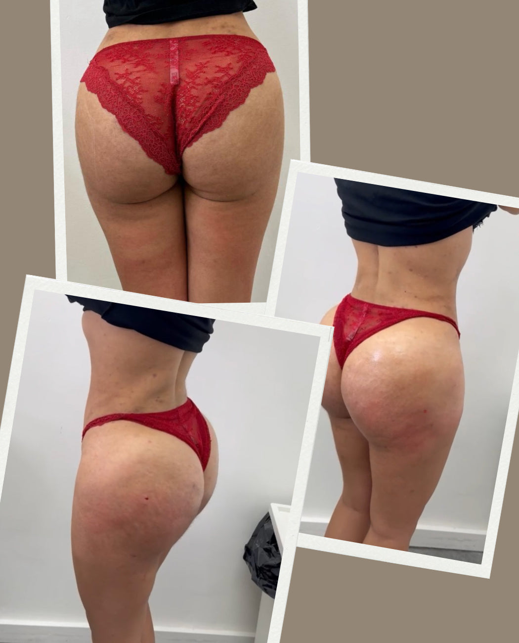 Brazilian Butt Lift / Hip Dip Filler 800ml