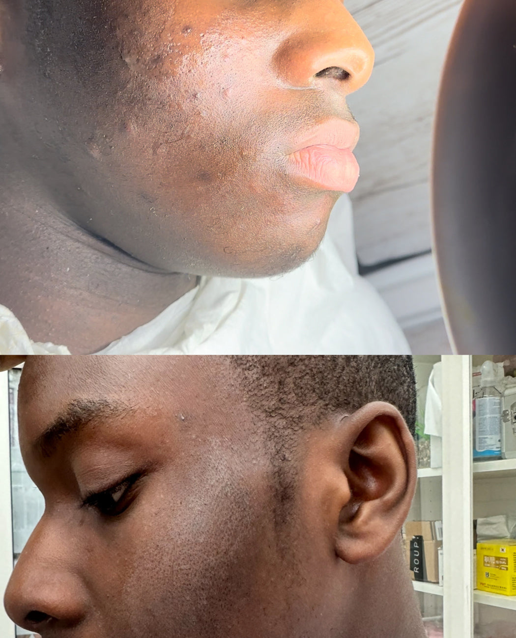 Bespoke acne clarifying facials