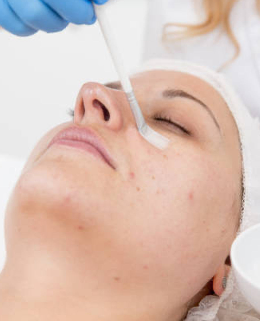 Blemish / Hyperpigmentation Peel