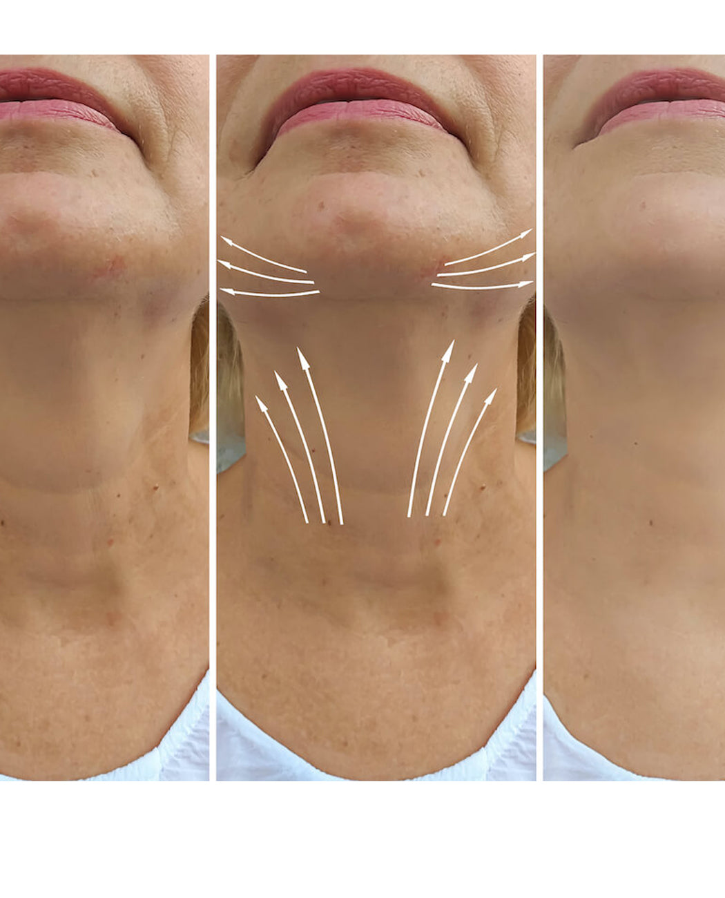 Neck Lift