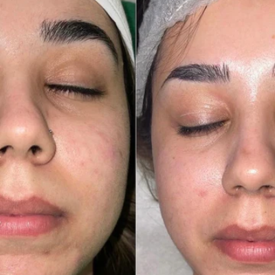 glow peel