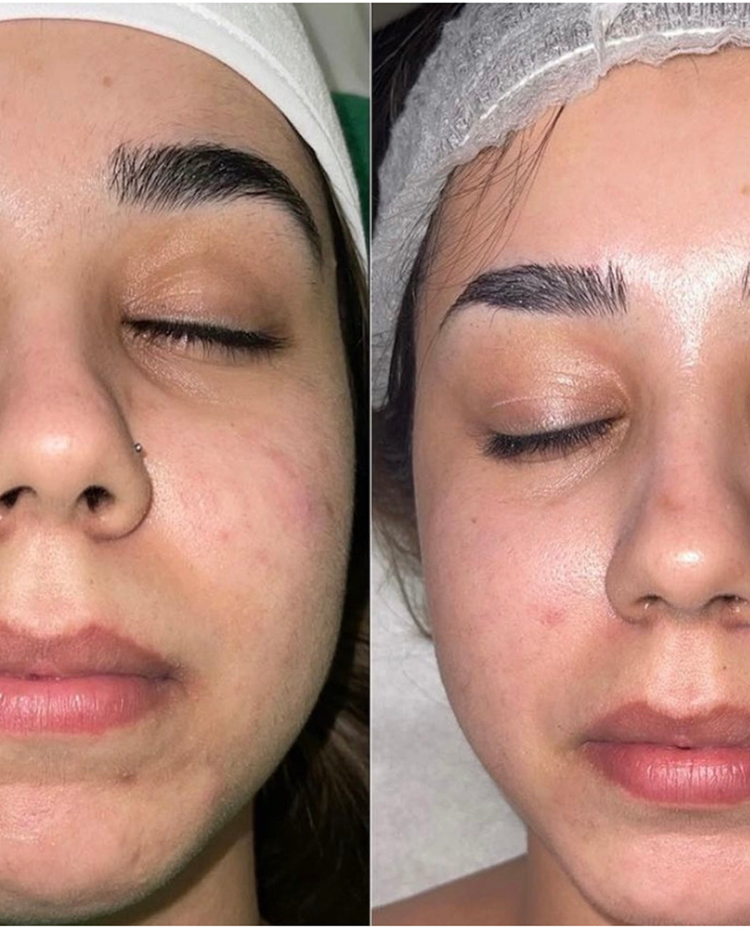 glow peel