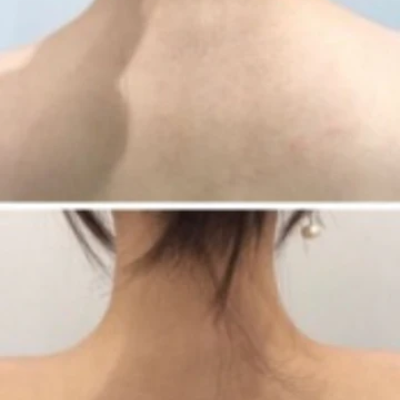 Trap / Shoulder (Hunch Shoulder)